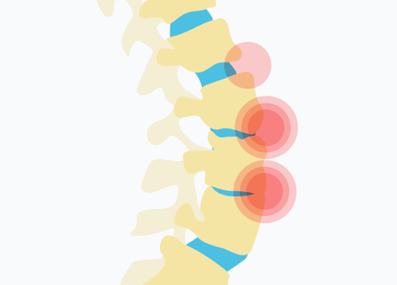 spondyloarthrite axiale